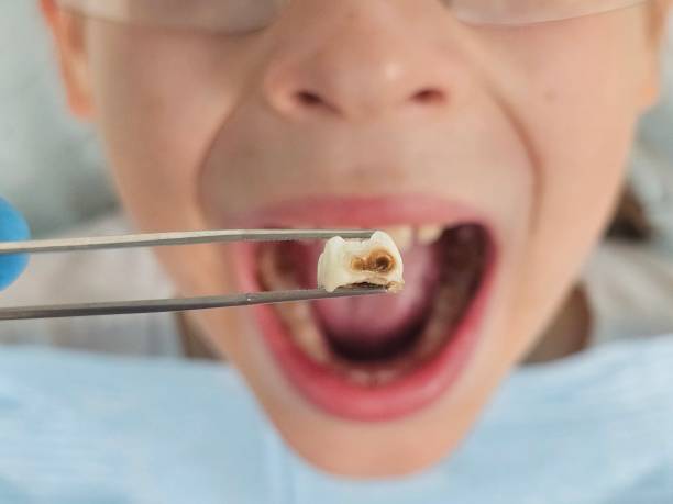 Best Emergency Treatment for Dental Infections or Abscesses in Ilion, NY